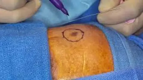 Shining a light on melanomas not caused by the sun